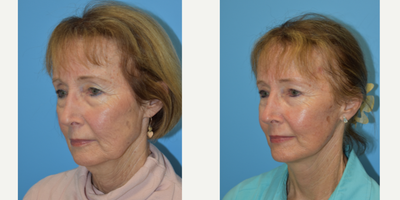 Facelift before and after photo