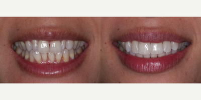 Invisalign before and after photo