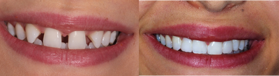 Invisalign before and after photo