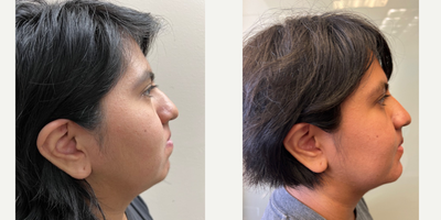 Jaw Surgery before and after photo