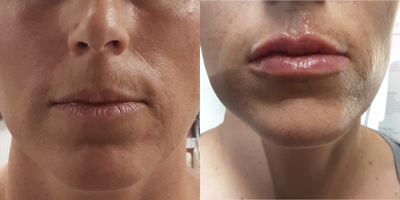 Juvederm before and after photo