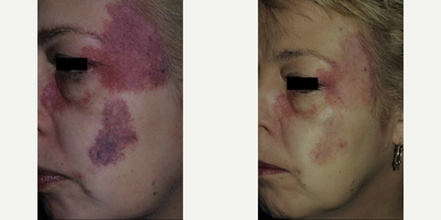 Vbeam before and after photo