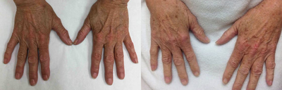 IPL before and after photo
