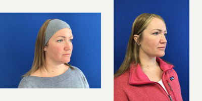 Liposuction before and after photo