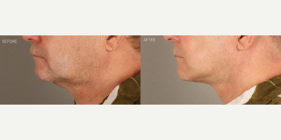 Neck Lift before and after photo