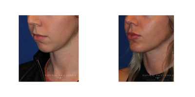 Rhinoplasty before and after photo