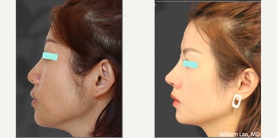 Rhinoplasty before and after photo