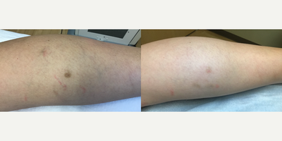 IPL before and after photo