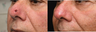 Mohs Surgery before and after photo