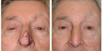 Rhinoplasty before and after photo