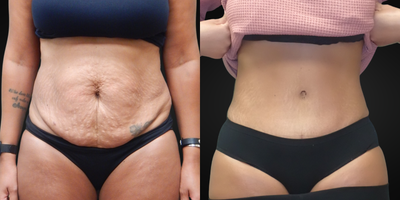 Tummy Tuck before and after photo