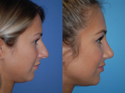 Rhinoplasty before and after photo