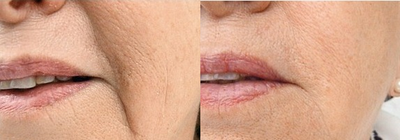 Belotero before and after photo