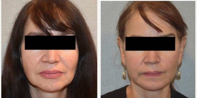 Facelift before and after photo