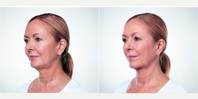 Juvederm before and after photo