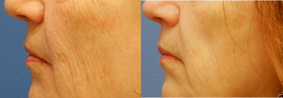 Thermage before and after photo