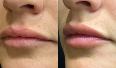 Juvederm before and after photo