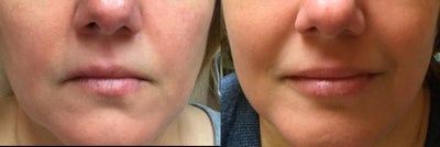 Lip Fillers before and after photo