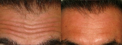 Botox before and after photo