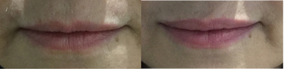 Dermal Fillers before and after photo