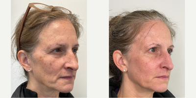 Halo Laser before and after photo