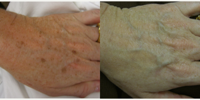 IPL before and after photo