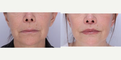 Laser Resurfacing before and after photo