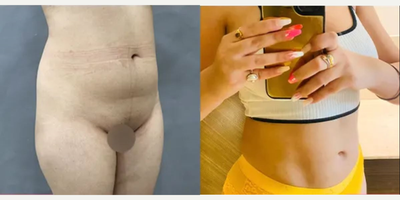 Liposuction before and after photo