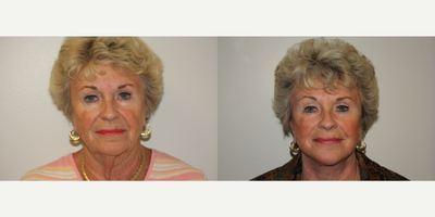 Lower Facelift before and after photo