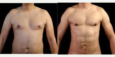 Abdominal Etching before and after photo