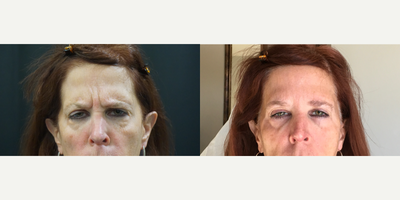 Botox before and after photo
