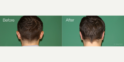 Ear Surgery before and after photo