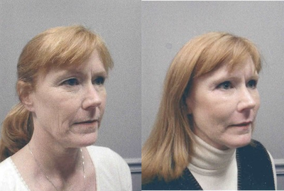 Facelift before and after photo