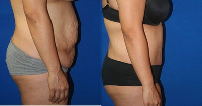 Tummy Tuck before and after photo