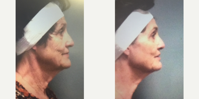 Ultherapy before and after photo