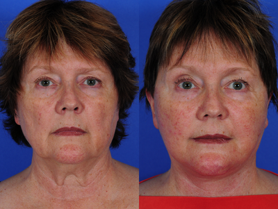 Facelift before and after photo