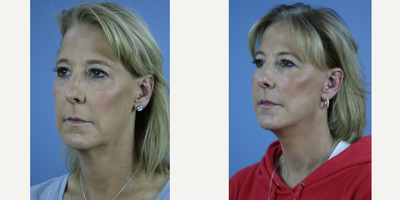 Neck Lift before and after photo