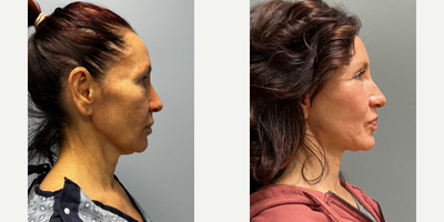 Renuvion before and after photo