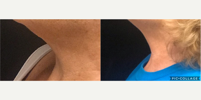 Skin Tightening before and after photo