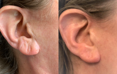 Skin Tightening before and after photo