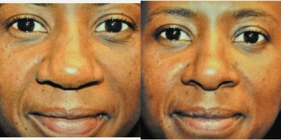African American Rhinoplasty before and after photo