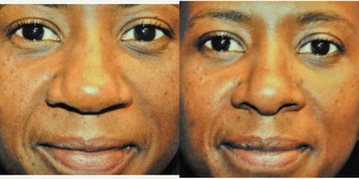 African American Rhinoplasty before and after photo