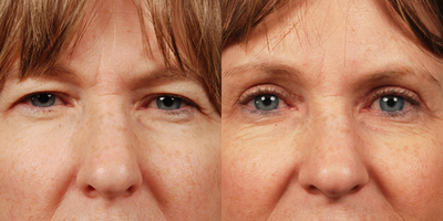 Brow Lift before and after photo