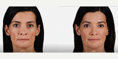 Dermal Fillers before and after photo