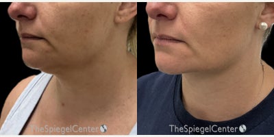 Neck Lift before and after photo