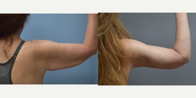 Arm Lift before and after photo