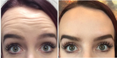 Dysport before and after photo