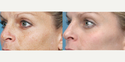 Skin Rejuvenation before and after photo