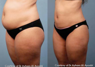 BodyTite before and after photo