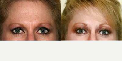 Brow Lift before and after photo